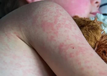 fourth measles case confirmed in durham region as exposure sites expand