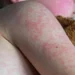 fourth measles case confirmed in durham region as exposure sites expand