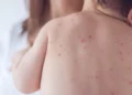 unimmunized child with measles may have exposed others in oshawa