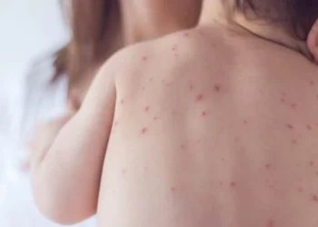 unimmunized child with measles may have exposed others in oshawa