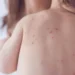 unimmunized child with measles may have exposed others in oshawa