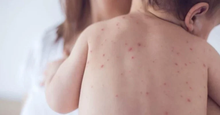 unimmunized child with measles may have exposed others in oshawa